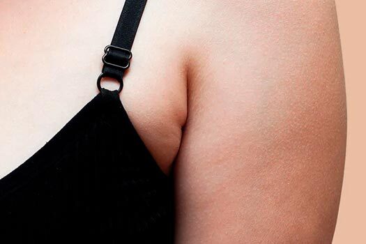 Imagem de mulher com mama axilar.